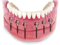 6-mini-implant-denture